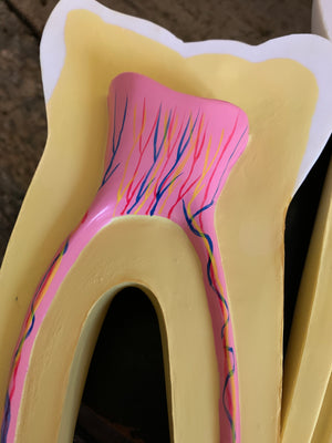 A set of three anatomical dental models of enlarged teeth